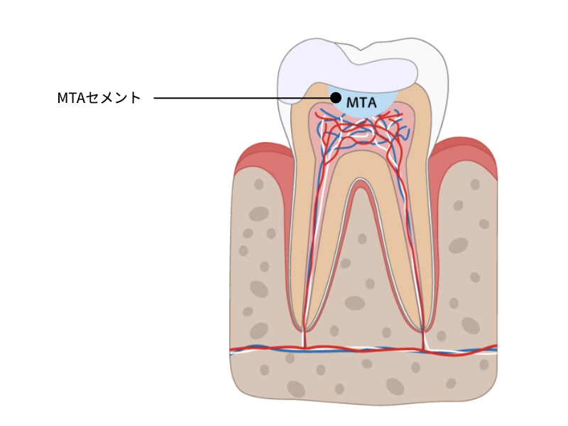 封鎖性と殺菌性に優れた歯の治療剤「MTAセメント」の使用