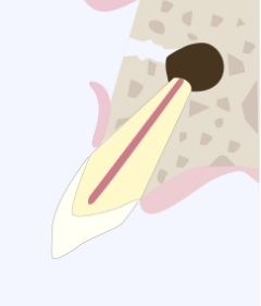 膿が溜まっている所まで骨を削除