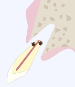 症状をしっかり確認した上で抜歯を行います