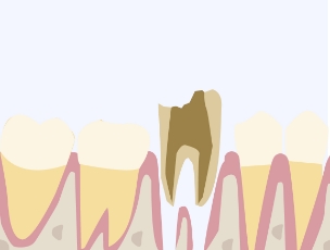 細菌感染などにより、残せなくなった歯の抜歯