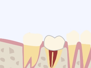 歯と骨がくっついたら被せ物を入れる