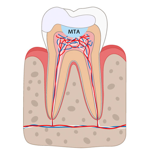 歯髄温存療法（MTA）